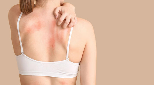 HOW SEASONAL ALLERGIES & POLLEN AFFECT YOUR SKIN