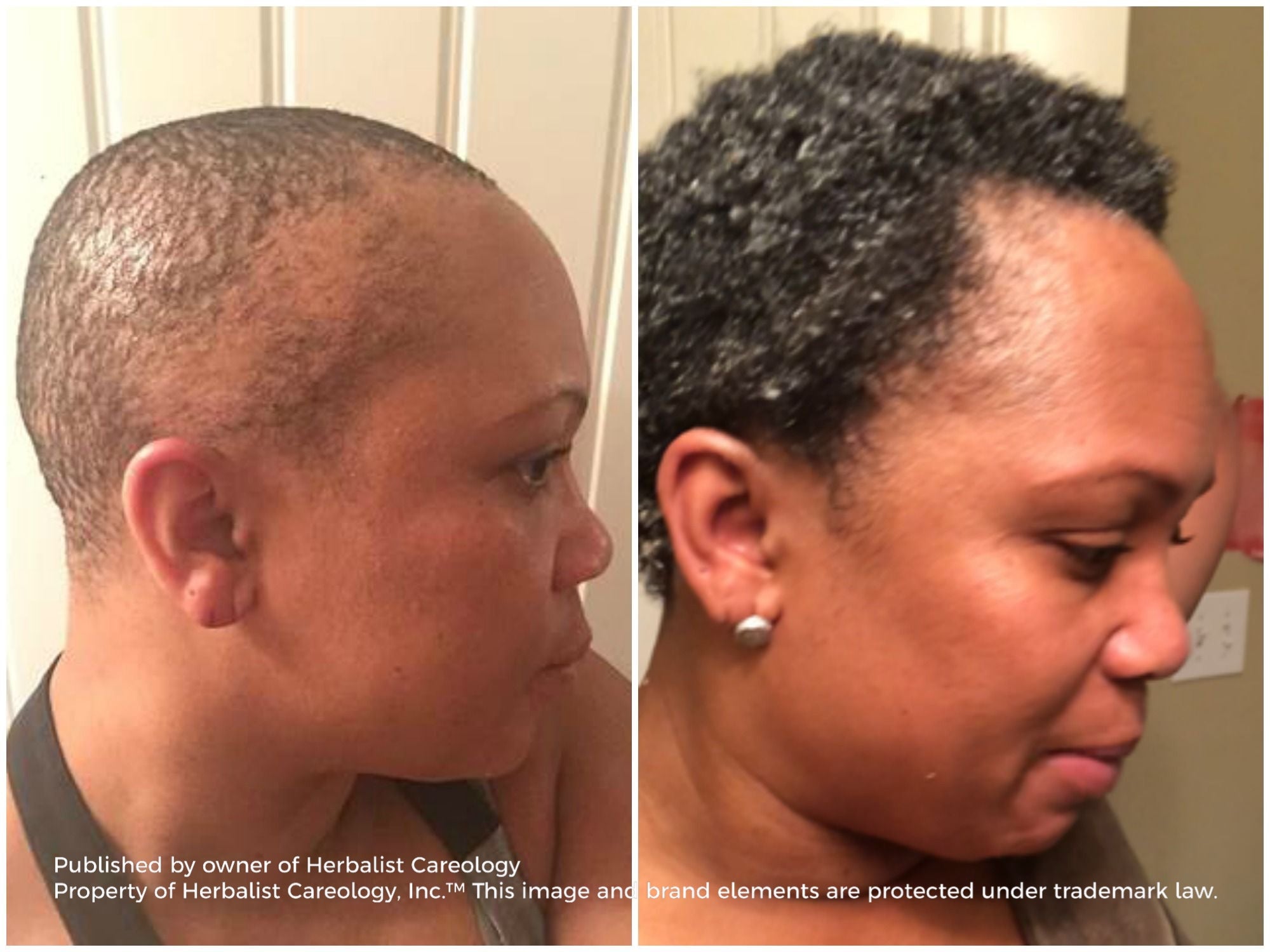 Side-by-side comparison of a person's head with and without hair, published by Herbalist Carelogy.